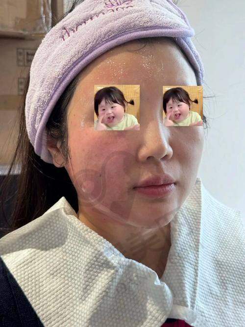 热玛吉紧致抗衰有哪些成效？