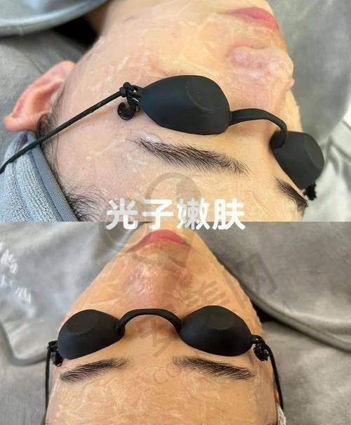 光子嫩肤真实实例
