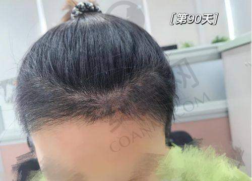 大理伊美东方丽人发际线种植的手术过程是怎样的？