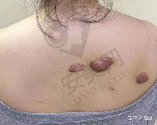 广州曙光整形医院疤痕修复的价格合理吗？