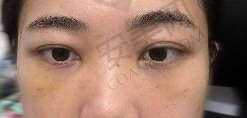 乐山达芬奇医疗美容做眼袋手术价格受哪些因素影响？