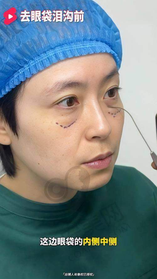 真实实例：见证微创不开刀去眼袋的神奇成效