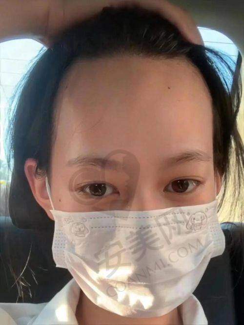大理伊美东方丽人发际线种植的成效能维持多久？
