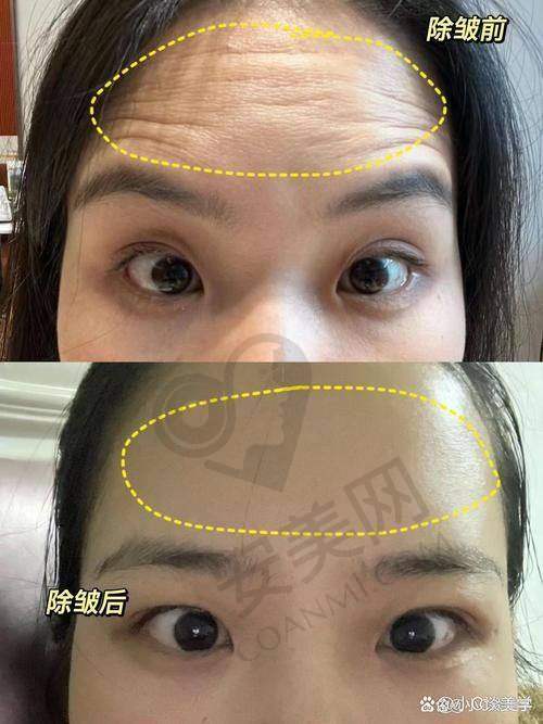患者对苏莉医生打除皱针的评价如何？