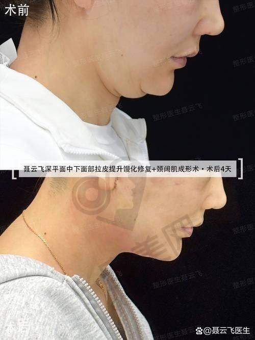 谢宏彬拉皮价格参考