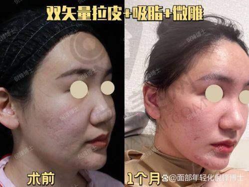 北京黄寺杜太超医生的Caw小切口面部提升值得尝试吗？