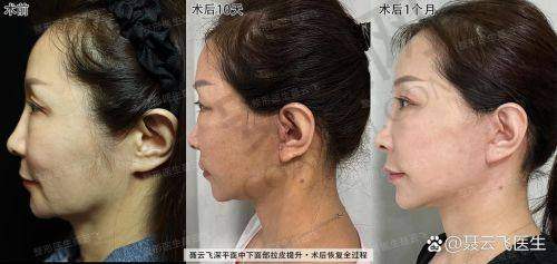 北京奥尔贝德谢宏彬拉皮手术靠谱吗？