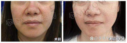 术后修复情况如何？