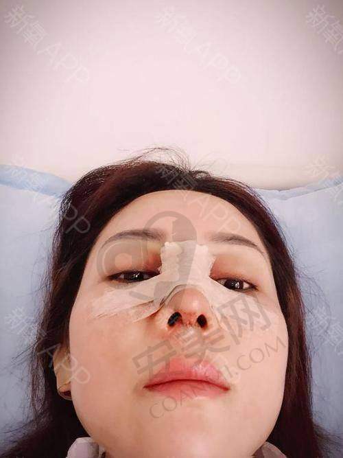 绍兴维美耳软骨隆鼻，成效真的好吗？