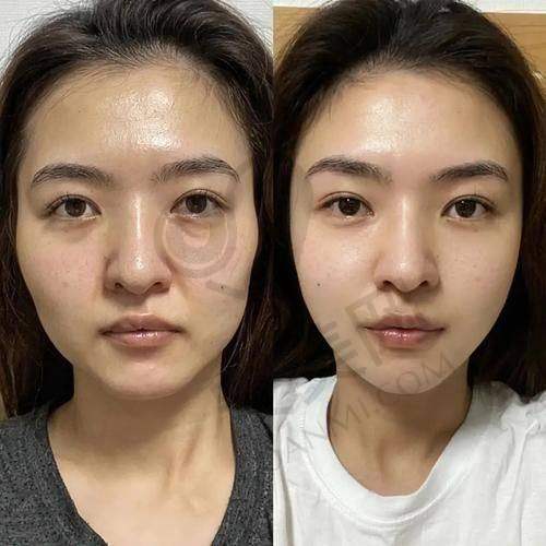 PSV面部提升的成效能维持多久？
