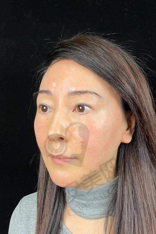北京黄寺李晓东面部提升术后修复情况如何？