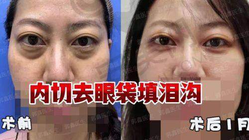 乐山达芬奇医疗美容做眼袋手术的性价比如何？
