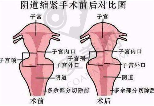 福州爱美尔整形医院疤痕修复成效如何？