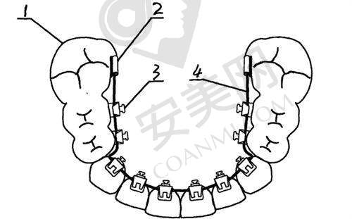 乌鲁木齐福宏林口腔牙齿矫正有哪些方式可选？