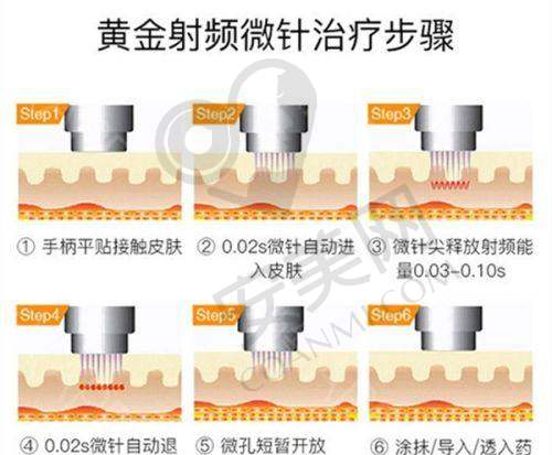 青岛诺美德黄金微针美肤成效如何？
