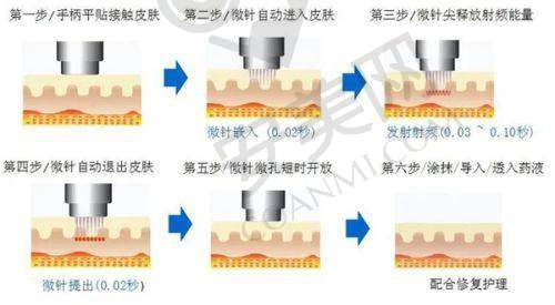 青岛诺美德黄金微针美肤治疗过程是怎样的？
