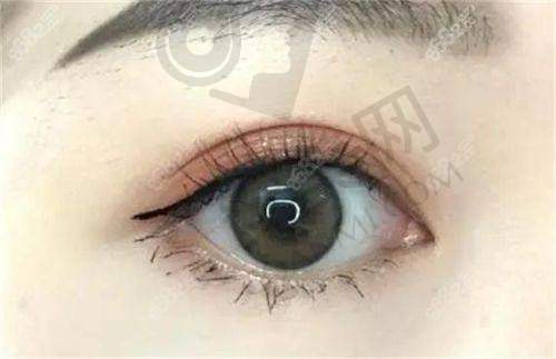 郑小红双眼皮修复实例分享