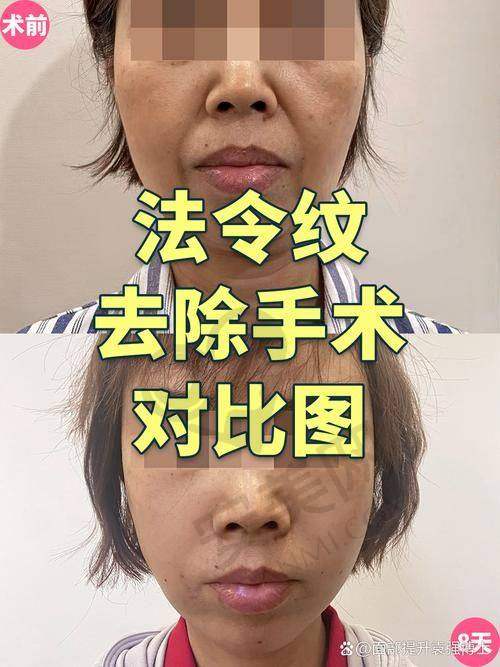 如何选择适合自己的玻尿酸品牌和塑形项目？