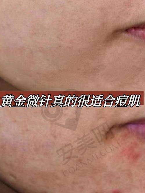 黄金微针价格究竟几何？