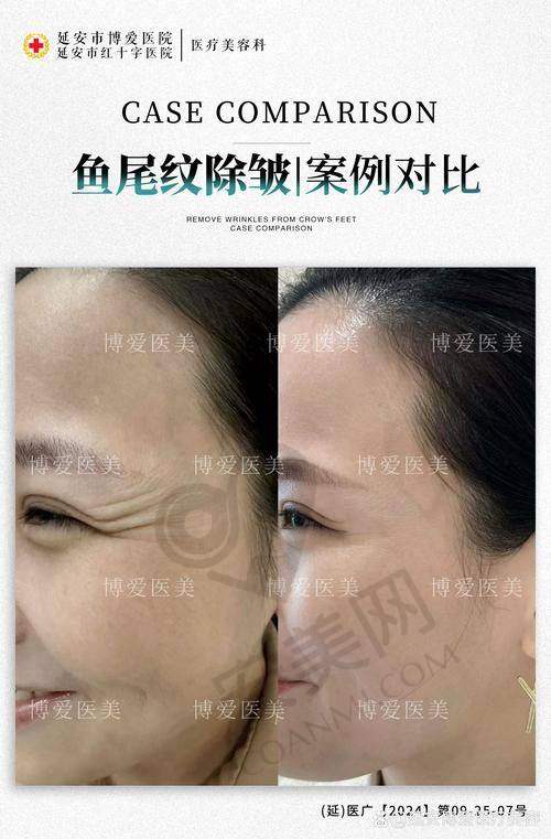 超玛吉tc眼廓拉提治疗后成效如何？