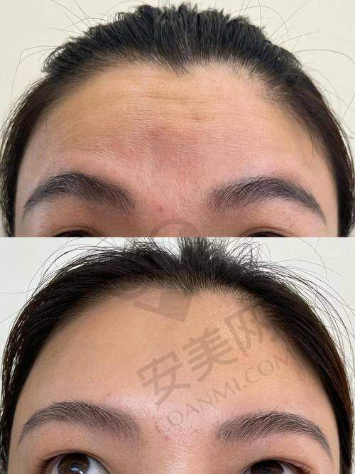常州美贝尔打除皱针的技术特色是什么？
