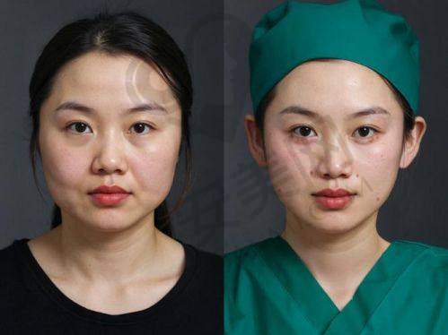 除皱针价格体系：多种选择满足不同需求