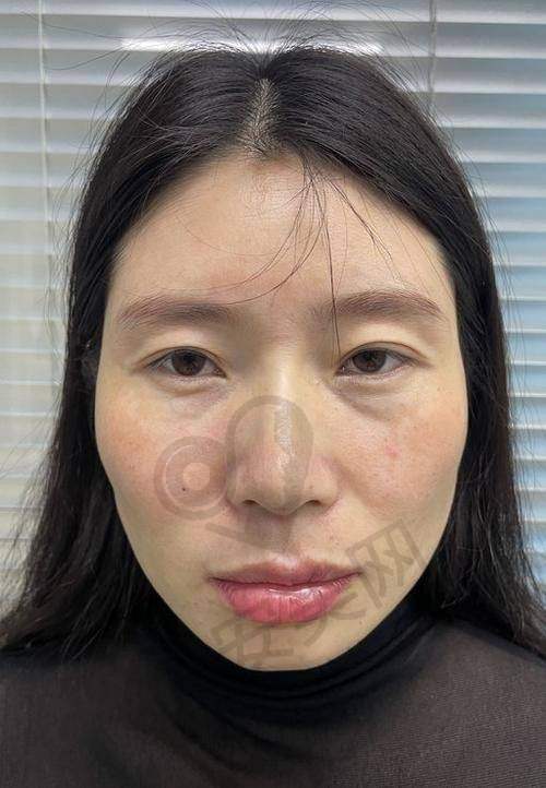 修复期间需要注意什么？