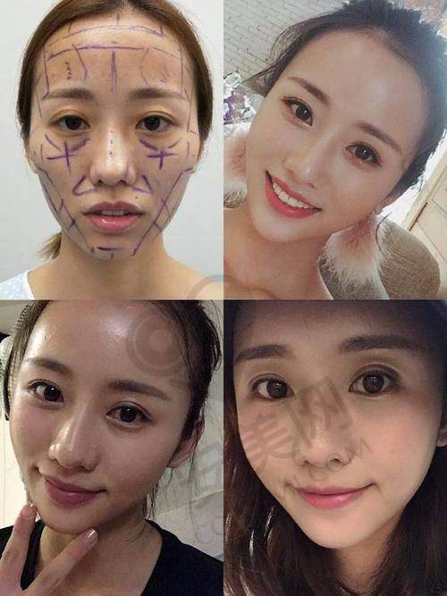 为什么选择南昌佳美进行濡白天使填充？