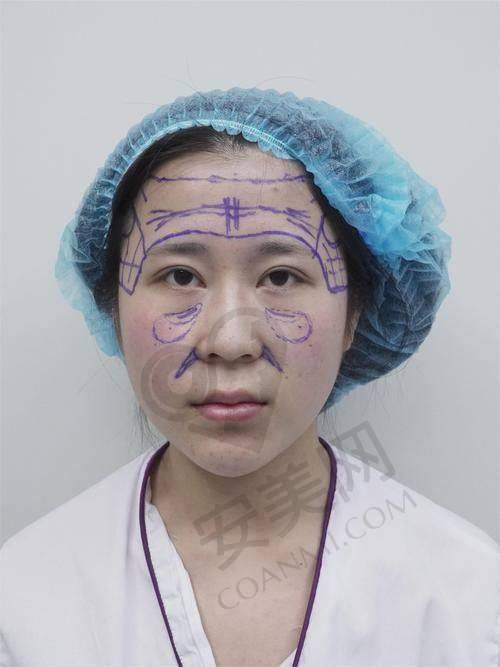 濡白天使填充的成效如何？