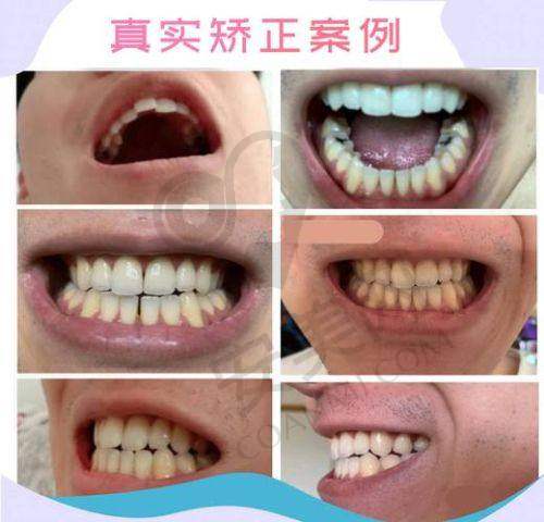 牙齿隐形矫正技术有哪些特色？