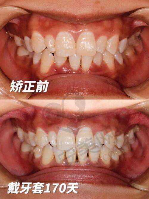 佩戴隐形矫正器是什么感觉？