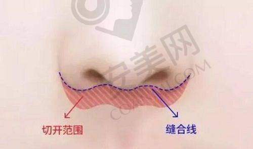冯传波 | 南方医 科 大学南方医院 - 整形外科