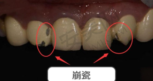普通无铍烤瓷冠是什么？