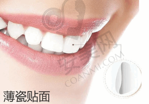 广西玉林蓝天口腔牙齿贴面美白的特色是什么？