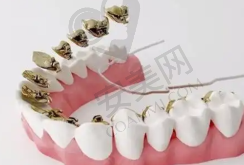 牙齿矫正后需要注意什么？