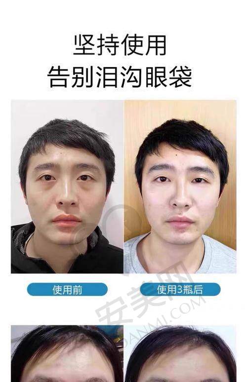 广州健丽去眼袋医院的技术实力如何？
