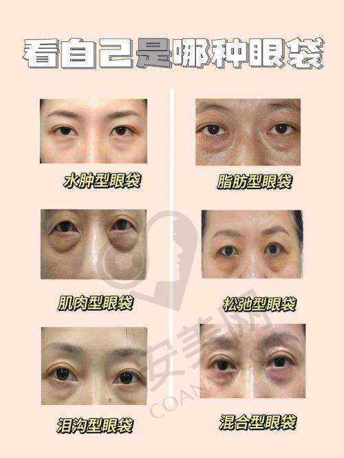 广州健丽祛眼袋的成效能持久吗？