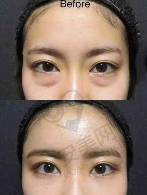总结：广州健丽祛眼袋值得选择吗？