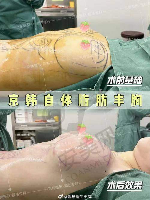 湛江韩美胸部整形有哪些特色项目？