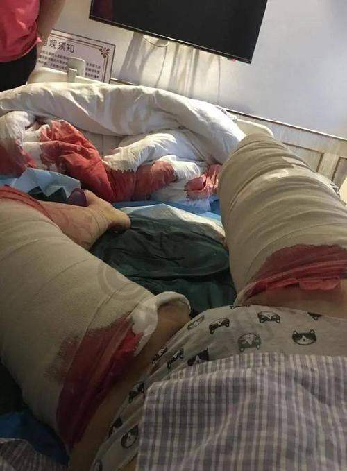 广州艺星邓晟华院长大腿吸脂价格为何如此吸引人？