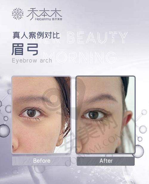 哲晨子玻尿酸的价格解析