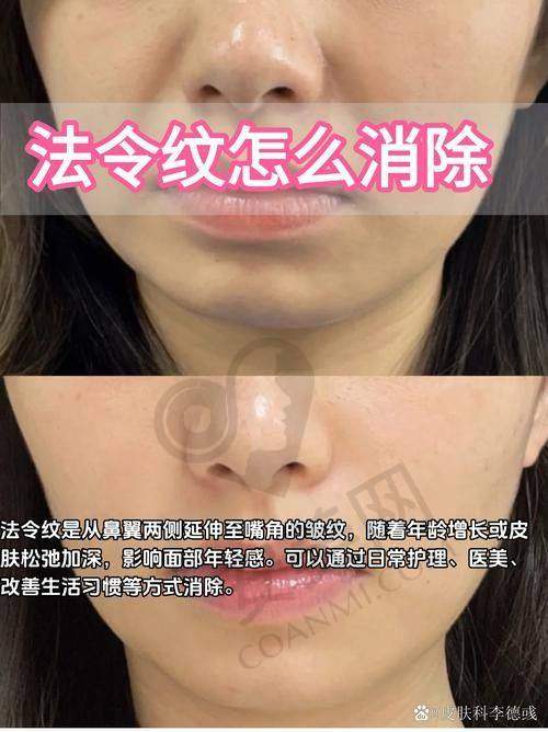 玻尿酸注射祛法令纹后如何护理？
