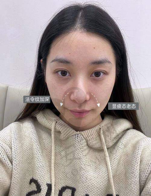 大连星妍玻尿酸填充法令纹技术有什么特色？