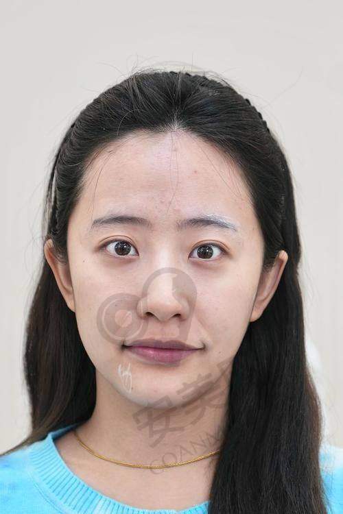 玻尿酸填充法令纹，疼不疼？