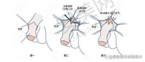 阴茎注射延长项目的成效如何？