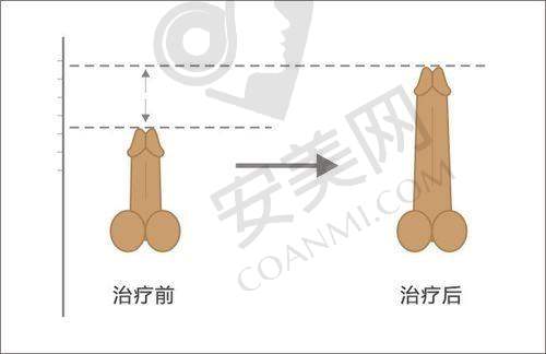 重庆星荣吕魏医生带来阴茎注射延长项目，仅 25000 元起开启男性自信之旅 