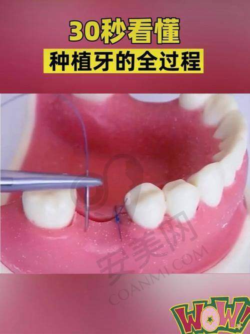 深圳新安麦芽口腔种植牙材料质量好吗？