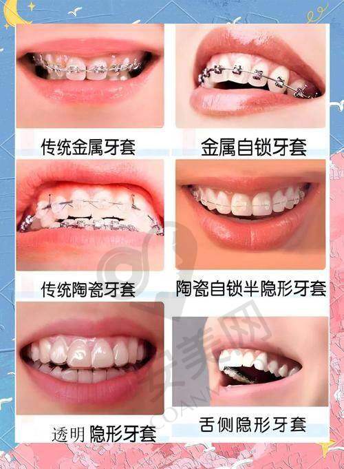金属托槽矫正需要注意什么？