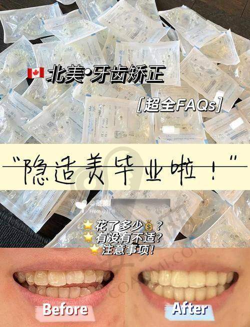 隐适美隐形矫正的价格分阶情况是怎样的？