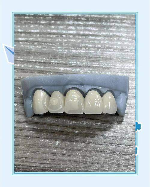 清远粤美口腔推出普通无铍烤瓷冠，450元起/颗，实惠之选焕新口腔！ 